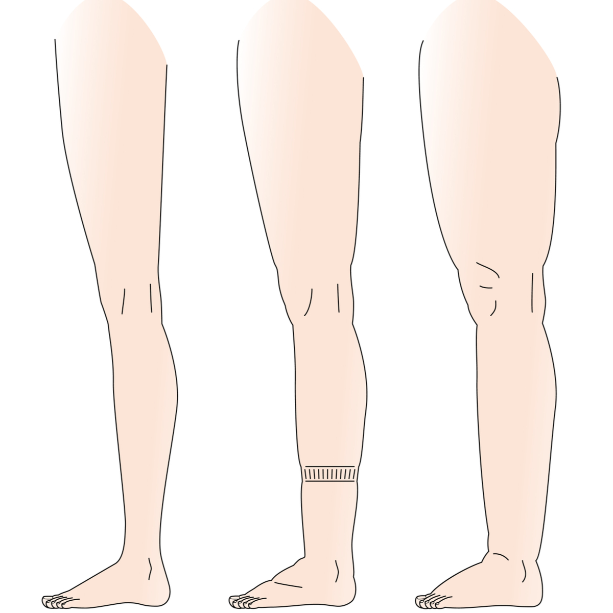 lymphedema treatment specialist